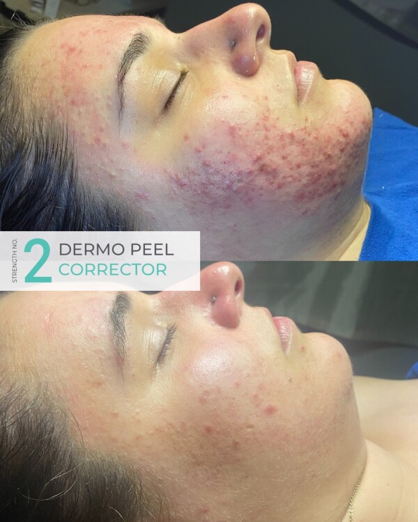 DermaPeelNo.2Ergebnisse